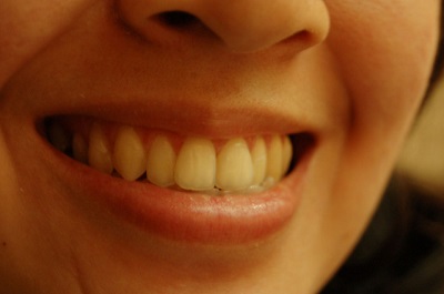 Zdrowe zęby- o tym warto wiedzieć 8